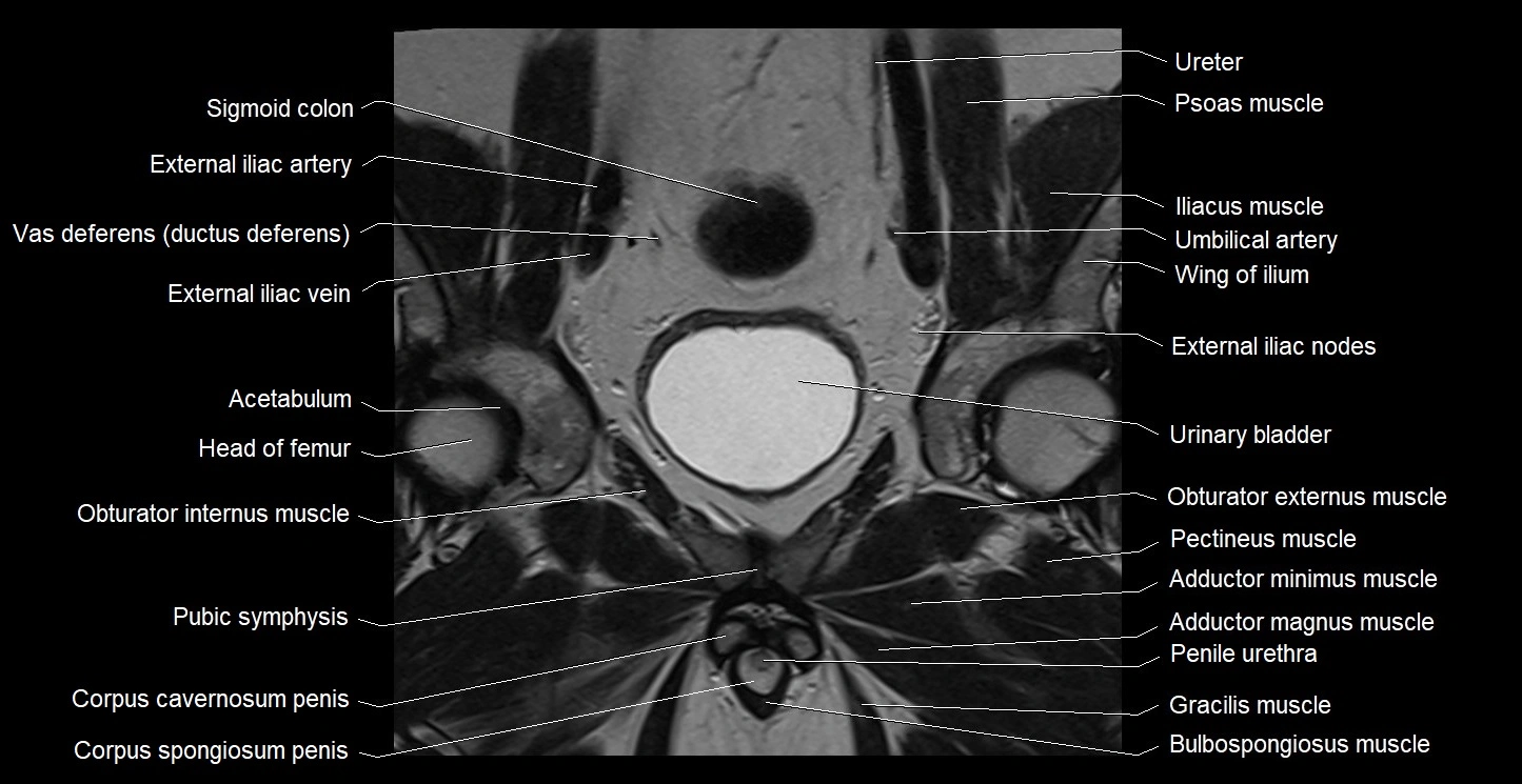 MRI coronal cross sectional anatomy male pelvis image 15.webp